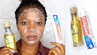 EVERYNIGHT APPLY COLGATE TOOTHPASTE AND OLIVE OIL WATCH WHAT HAPPENS TO YOUR FACE IN 5 MINUTE