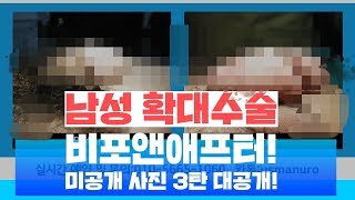 성기확대 수술 그후 포토이야기 - 전후사진 대방출! [자가지방 남성수술 편]