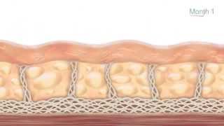 How the Ultherapy Treatment Works