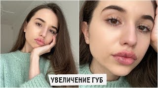 УВЕЛИЧЕНИЕ ГУБ / мой опыт / ВСЯ ПРАВДА!