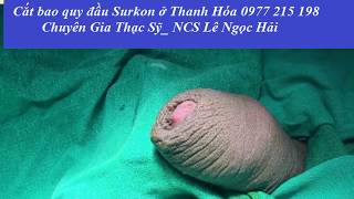 Cắt bao quy đầu theo phương pháp truyền thống ở bệnh viện 0977 215 198