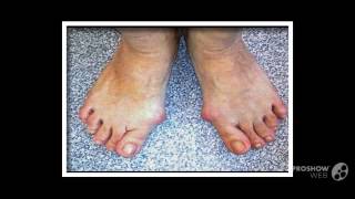 припухла косточка на ноге

  - рекомендую лечение hallux valgus косточки