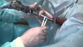 Цистолитотрипсия камни мочевого пузыря Cystolithotripsy bladder stones