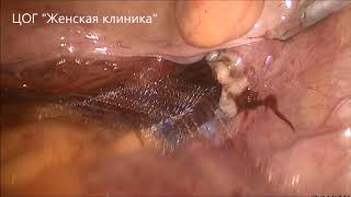 Апоневротическая Mesh вагинопексия(латеральная фиксация)