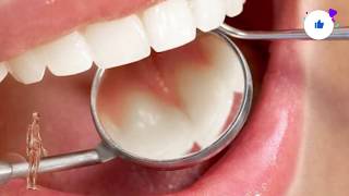 Si të zbardhni dhëmbët dhe largoni gurëzat për 5 minuta, natyralisht dhe pa shkuar tek dentisti!