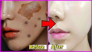 ঘরে বসে চেহারা থেকে ডার্কস্পট,কালচে ছোপ ও কালো দাগ দূর করার উপায়।কালো চেহারা ফর্সা করার সহজ উপায়।
