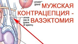 Мужская контрацепция – Вазэктомия / Доктор Черепанов