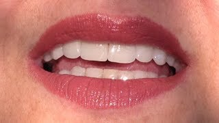 Os Preços São Bem Acessíveis das Próteses Dentárias de Silicone Removíveis?
