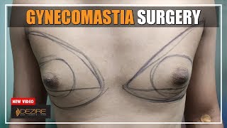 Men Puffy Chest ! Man Boobs Reduction ( Gynecomastia Surgery ) By Dr. Prashant Yadav