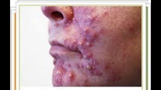 pimple popping. выдавливание прыща,угри на лице.