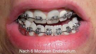 GNE OP  und Multibandbehandlung (Zahnspange)  - Vorbereitungsphase Kieferoperation