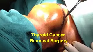 Total Thyroidectomy Removal Surgery by Dr Majid Ahmed Talikoti