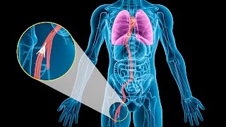 Are IVC Blood Filters Causing More Harm Than Good? - The Ring Of Fire