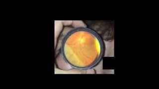 iphoneで眼底検査　fundus  of retinal detachment is checked by iphone