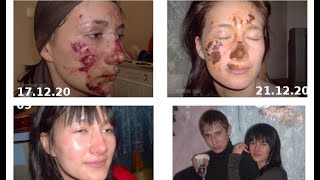 Ожог, восстановление кожи за 10 дней