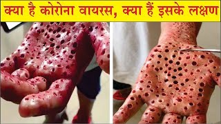 कोरोना वायरस क्या है / कोरोना वायरस के लक्षण क्या है / Corona virus symptoms / Coronavirus Lakshan