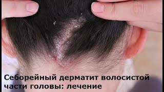 Дерматит - симптомы и лечение.