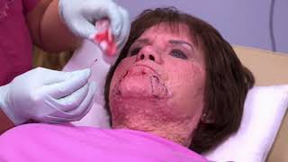 Dr Pimple Popper Seson 1 Episode 4 - The Curious Case of the Pooting Cyst