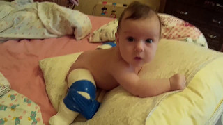 врожденный вывих бедра у ребенка(Congenital hip dislocation)