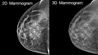 Huge study puts 3D mammogram to the test
