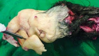 ОПУХОЛЬ-ПАРАЗИТ С ВОЛОСАМИ И ЗУБАМИ