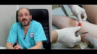 Липоматоз - причины, лечение, операции, стоимость.