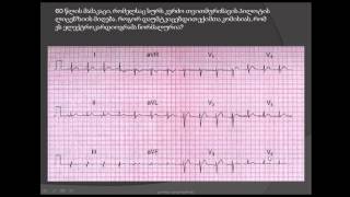 ეკგ / პილოტის ელექტროკარდიოგრამა / Q კბილები და T კბილების ინვერსია III განხრაში