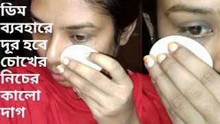 ডিম দিয়ে দূর হবে চোখের নিচের কালো দাগ || Dark circle remove
