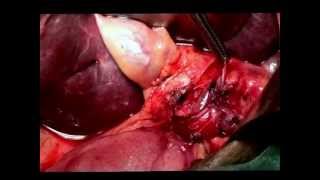 Right Liver Resection. - Dr Sharad Desai, MGCH