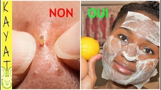 ?VOILA COMMENT ENLEVER DÉLICATEMENT LES GROS POINTS NOIRS ET LA GRAISSE/SÉBUM DU VISAGE ??