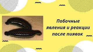 Пиявки: побочные явления. Приставочная реакция после пиявок
