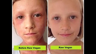 Raw Food Skin Before And After Transformation (With Photos)