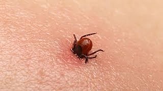 How to remove a tick the easy way. Tick Key Review - Tick Remover review.