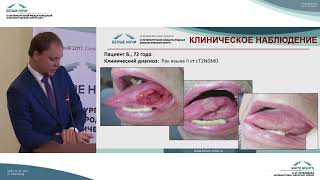 Определение прогноза эффективности лечения плоскоклеточного рака полости рта и глотки