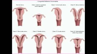 Congenital Uterine Abnormalities - CRASH! Medical Review Series