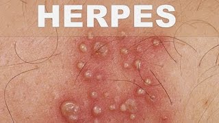 ☞ Remedios caseros para el herpes – Como combatir el herpes en los genitales y labios en casa