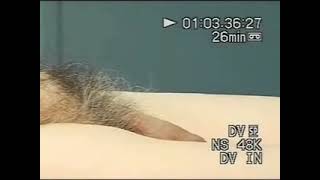 Demo of Patient with Penile Implant in the Supine Position