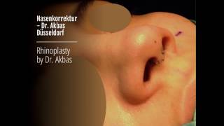 Nasenkorrektur in Düsseldorf - Dr. Akbas Rhinoplastik