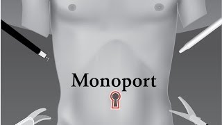 Операции через пупок. SILS холецистэктомия.