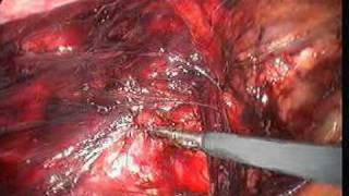 Lap orchidectomy with Hernia Repair (TAPP) by Dr Mahesh Rao