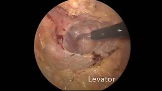Laparoscopic sigmoid resection, rectopexy for rectal prolapse