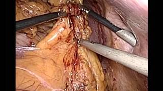 Laparoscopic subtotal gastrectomy (Лапароскопическая дистальная субтотальная резекция желудка)