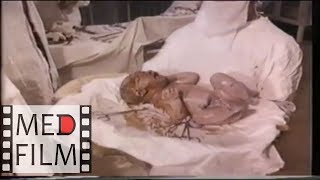 Кесарево сечение в нижнем маточном сегменте поперечным разрезом © Caesarean section in lower segment