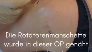 Fäden Entfernung nach Schulter Operation