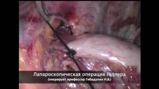 Лапароскопическая операция Геллера (выполняет профессор Гибадулин Н.В.)