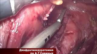 Лапаро-торакоскопическая экстирпация пищевода