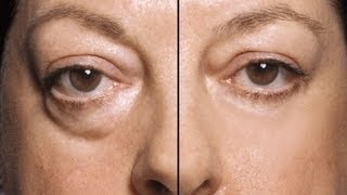 HOW TO: MAKE UNDER EYE BAGS DISAPPEAR IN SECONDS!!!!