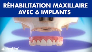 Réhabilitation du maxillaire avec 6 implants dentaires ©