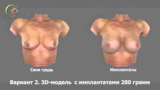 3D моделирование груди, увеличение груди, маммопластика