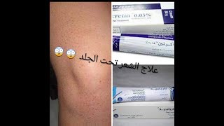 اقوى طريقة فعالة للتخلص من الشعر تحت الجلد